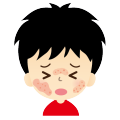 はしか(麻疹)